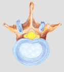 herniated disk